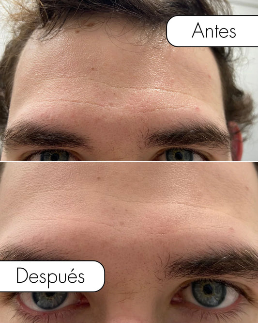 KIT Depiladora IPL + Serum